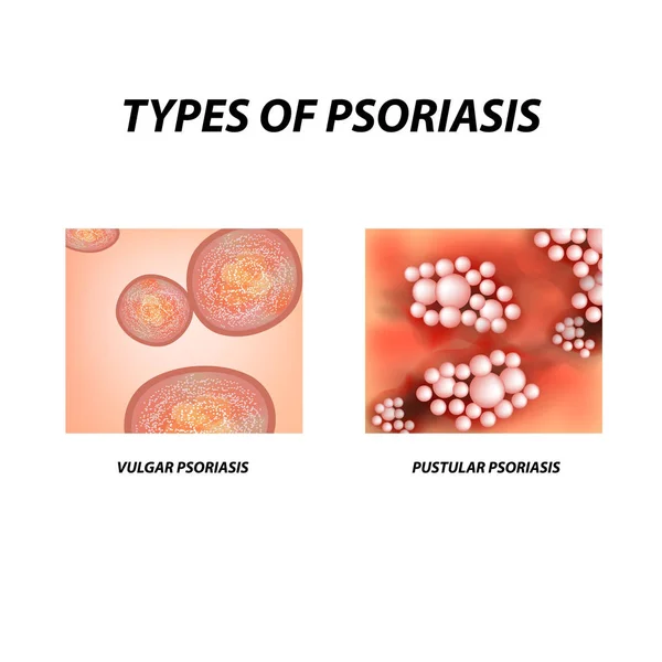 Typy Lupénky Pustulární Pustulózní Psoriáza Ekzém Kožní Onemocnění Dermatitida Infografika — Stockový vektor