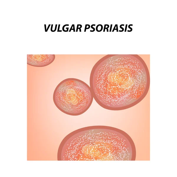 Psoriasis Vulgar Tipo Pustuloso Psoriasis Eccema Dermatitis Cutánea Infografías Ilustración — Vector de stock