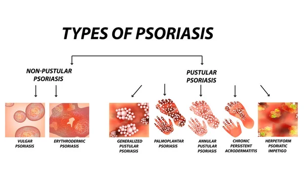 Tipos Psoriasis Pustular Pustular Vulgar Eritrodermia Psoriasis Eritrodérmica Acrodermatitis Persistente — Vector de stock