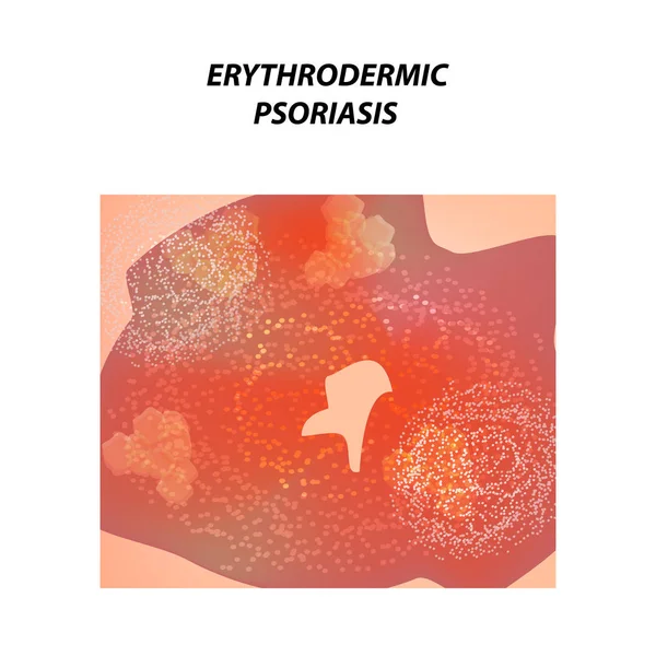 Psoriasis Eritrodérmica Eczema Dermatitis Psoriasis Piel Infografías Ilustración Vectorial Sobre — Vector de stock