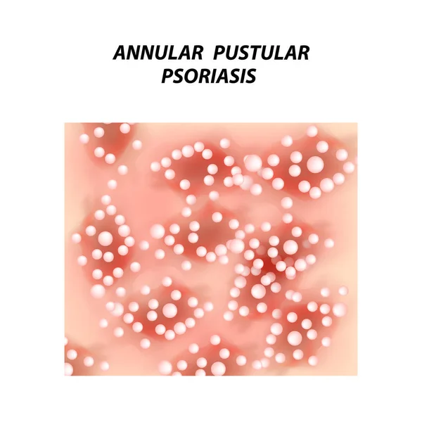 Psoriasis Pustulosa Anular Eczema Dermatitis Psoriasis Piel Infografías Ilustración Vectorial — Vector de stock