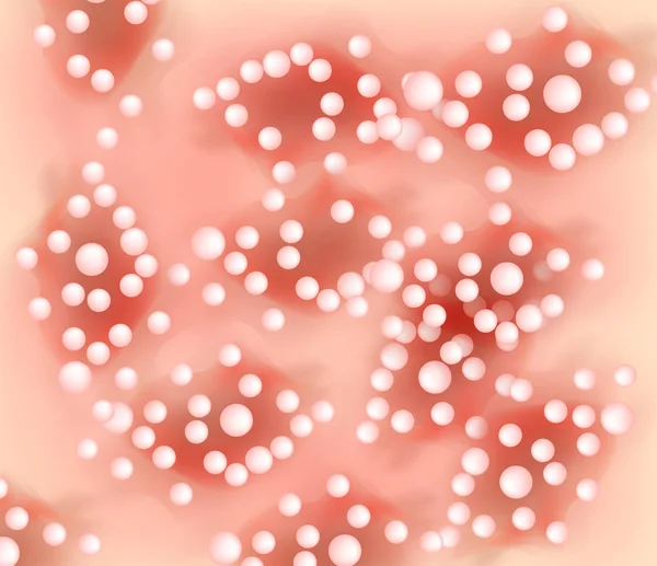 Annuly Püstüler psoriasis doku. Egzama Dermatit deri hastalığı sedef. Infographics. Vektör çizim