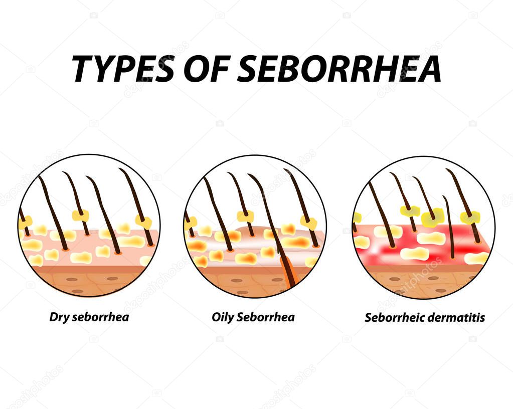 Types of seborrhea. Seborrhea skin and hair. Dandruff, seborrheic dermatitis. Baldness, hair growth, baldness. Anatomical structure. Infographics. Vector illustration on isolated background