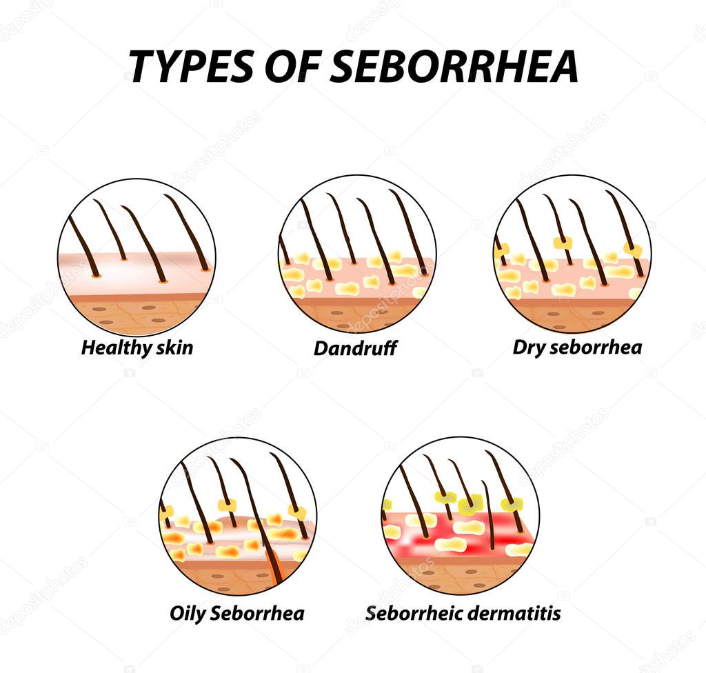 Types of seborrhea. Seborrhea skin and hair. Dandruff, seborrheic dermatitis. Baldness, hair growth, baldness. Anatomical structure. Infographics. Vector illustration on isolated background