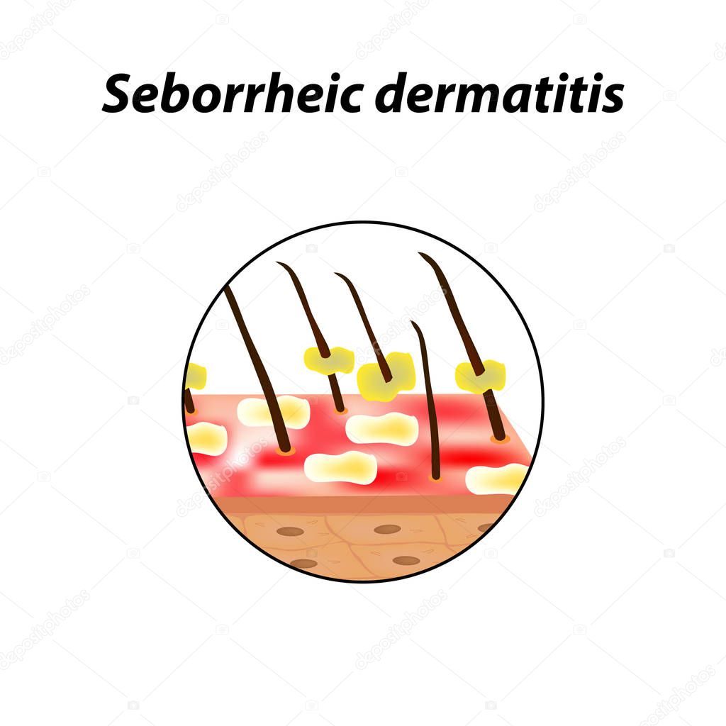 Seborrheic dermatitis of the skin and hair. Dandruff, seborrhea. Baldness, hair growth, baldness. Anatomical structure. Infographics. Vector illustration on isolated background