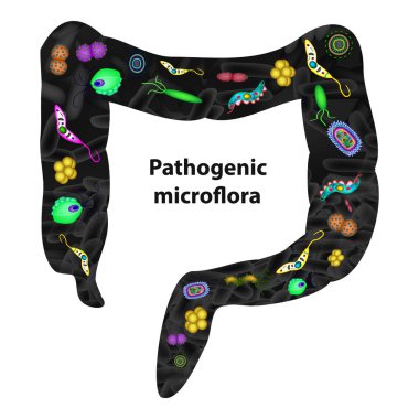 Pathogenic microflora in the intestine. Dysbacteriosis. Dysbiosis. Killed the good bacteria flora in the colon. Infographics. Vector illustration on isolated background clipart