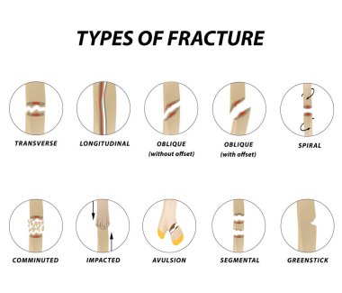 Types of fracture. Fracture bone set. Infographics. Vector illustration on isolated background clipart