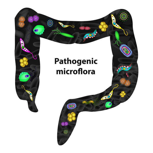 Pathogenic microflora in the intestine. Dysbacteriosis. Dysbiosis. Killed the good bacteria flora in the colon. Infographics. Vector illustration on isolated background