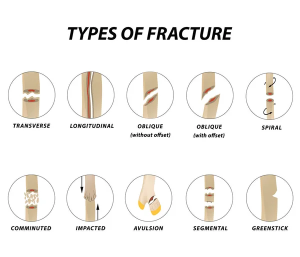 Types Fracture Fracture Bone Set Infographics Vector Illustration Isolated Background — Stock Vector
