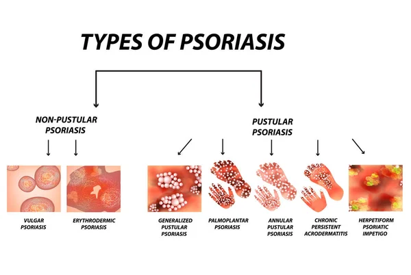 Tipos Psoriasis Pustular Pustular Vulgar Eritrodermia Psoriasis Eritrodérmica Acrodermatitis Persistente — Vector de stock