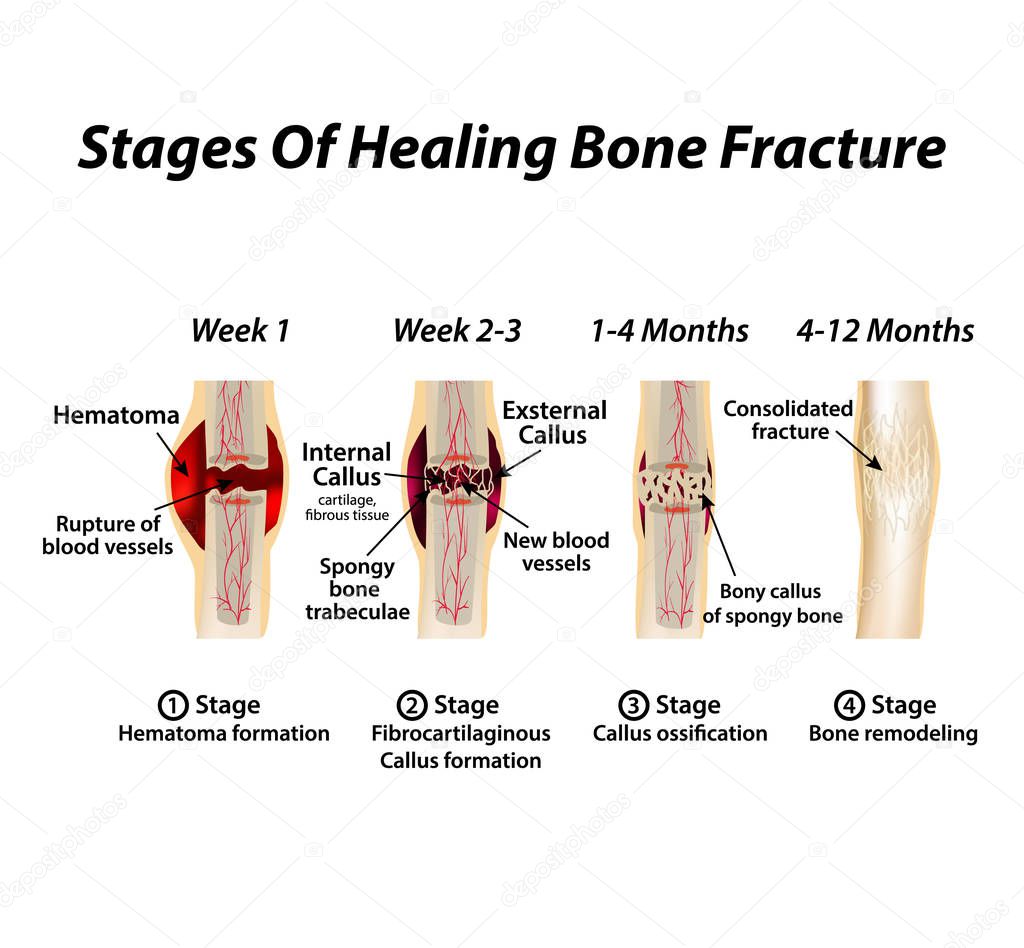 Stages Of Healing Bone Fracture. Formation of callus. The bone fracture. Infographics. Vector illustration on isolated background