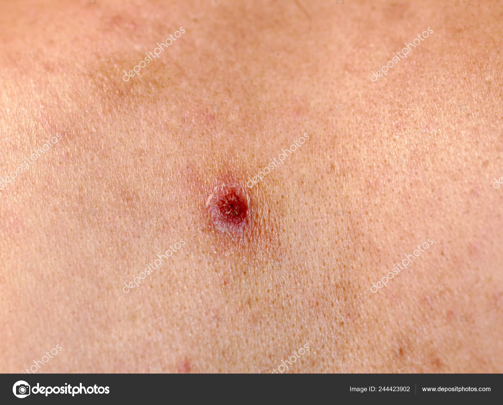 Torn off a bleeding pimple on the skin. Inflammation, acne. Stock Photo by  ©mikrostoker 244423902