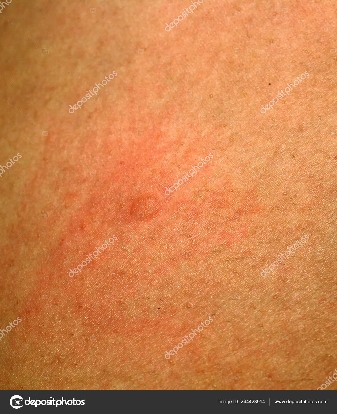 Prueba mantoux