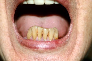 Alt çene tarafında dişleri vardır. Alt dişleri sarı farklı yükseklikleri. Parodontosis.