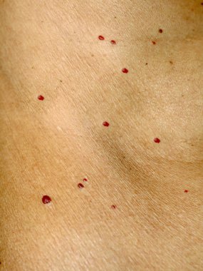 Angioma cilt üzerinde. Vücut üzerinde kırmızı benler. Pek çok doğum lekeleri.