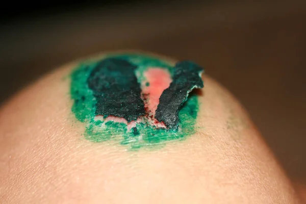 Ferida cicatrizante no joelho. A ferida tratada com verde brilhante. A crosta vai subir. — Fotografia de Stock