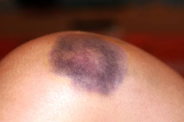 Injury of the knee joint. Big bruise on knee — Stock Photo, Image