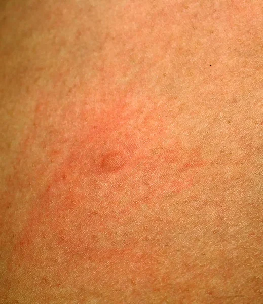 结核病疫苗接种曼图克斯检测。皮肤上的凸起红色粉刺 — 图库照片