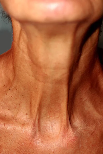 Ρυτίδες στο λαιμό. Πλαδαρό δέρμα στο λαιμό. — Φωτογραφία Αρχείου