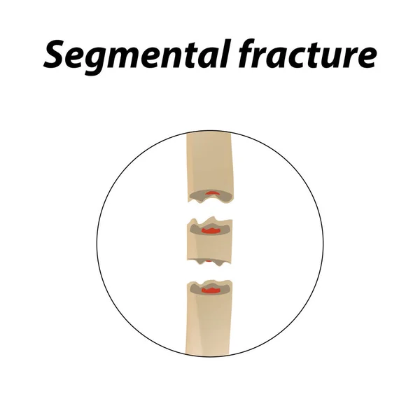 Segmental fracture Bone. Infographics. Vector illustration on a lined background. — Stock Vector