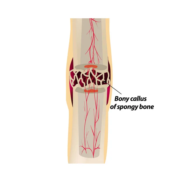 3 steg av Healing benfraktur. Callus förbening. Att benfraktur. Infographics. Vektorillustration på isolerade bakgrund. — Stock vektor