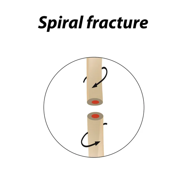 Spiral Bone Fracture. Infographics. Vector illustration on a lined background. — Stock Vector