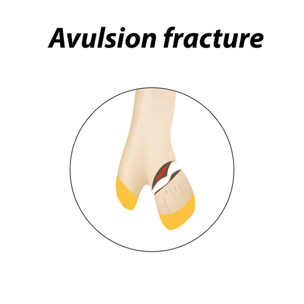 Avulsion zlomenina kosti. Infografika. Vektorové ilustrace na linkovaném pozadí. — Stockový vektor