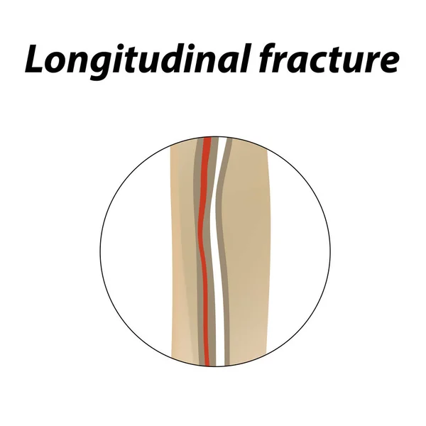 Fratura óssea longitudinal. Infográficos. Ilustração vetorial sobre fundo forrado . —  Vetores de Stock