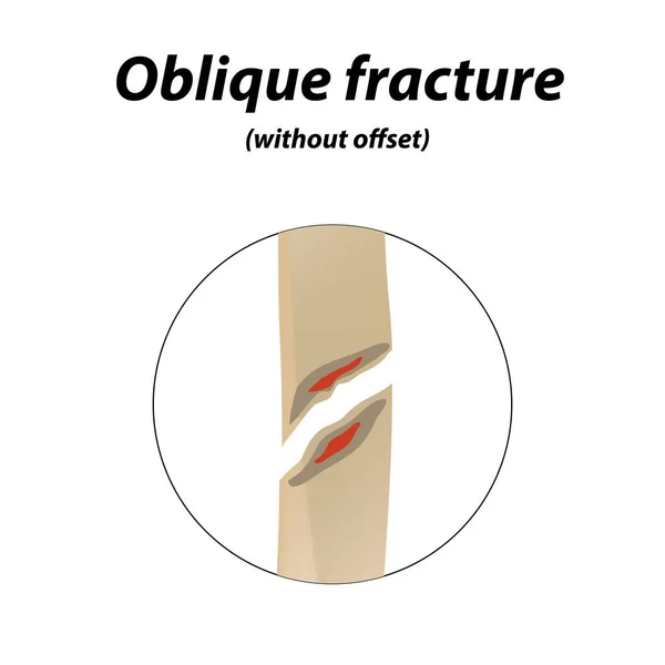 Oblique, without offset bone fracture. Infographics. Vector illustration on a lined background. — Stock Vector