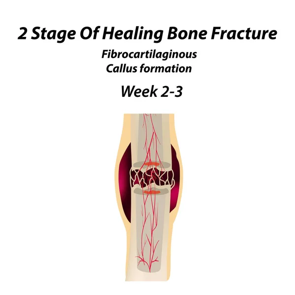 2 Estágio de fratura óssea de cura. Formação de calo. A fractura óssea. Infográficos. Ilustração vetorial sobre fundo isolado . — Vetor de Stock