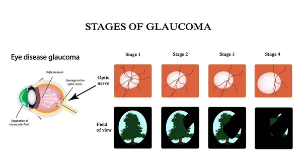 Glaucoma. Struktur dari mata. Bidang penglihatan dalam glaukoma. Atrofi saraf optik. Infografis. Ilustrasi vektor pada latar belakang terisolasi - Stok Vektor