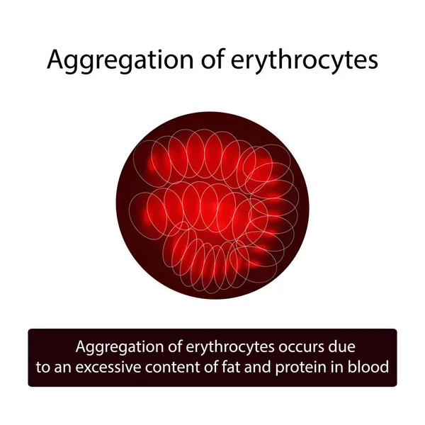 Agrégation des globules rouges. Des érythrocytes. Illustration vectorielle sur fond isolé — Image vectorielle