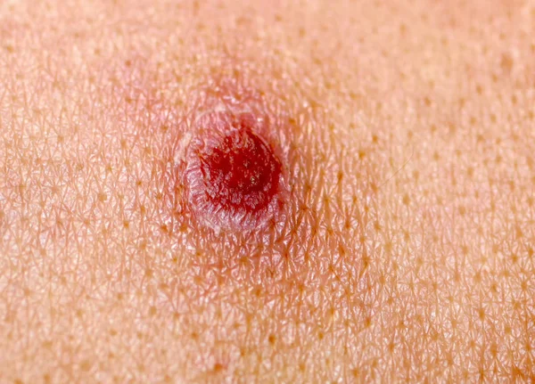 Ulcer on the skin. Smallpox. A wound, an abrasion, a cut, a scab. Chickenpox. — Stock Photo, Image