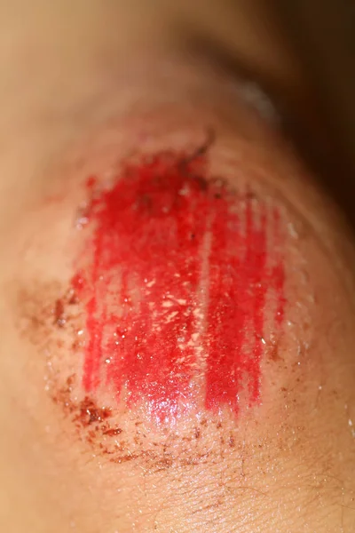 A ferida tem sangue no joelho. Lesão do joelho — Fotografia de Stock