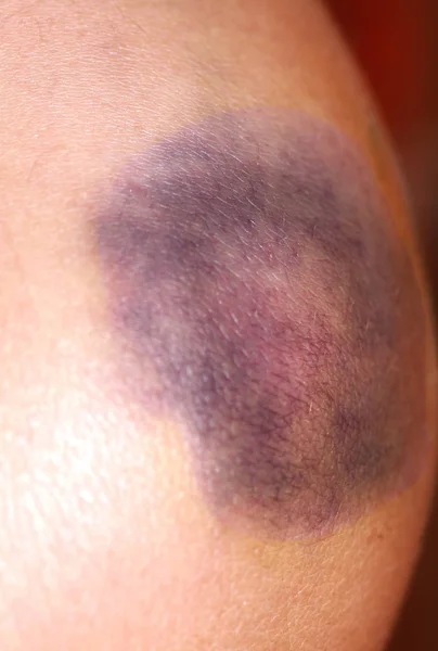 Injury of the knee joint. Big bruise on knee — Stock Photo, Image