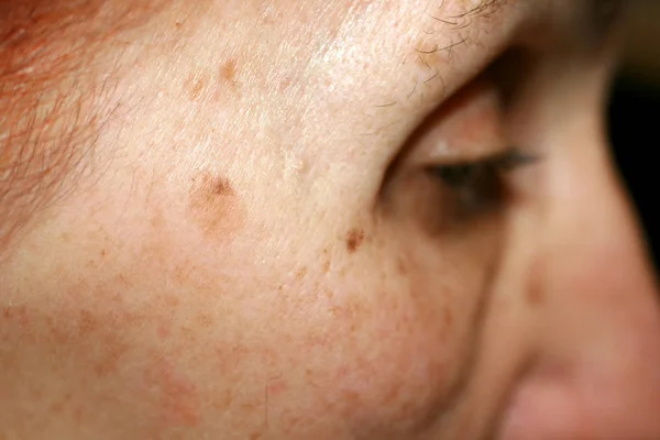 Pigmentation on the face. Brown spot on cheek. Pigment spot on the skin. Profile. — Stock Photo, Image