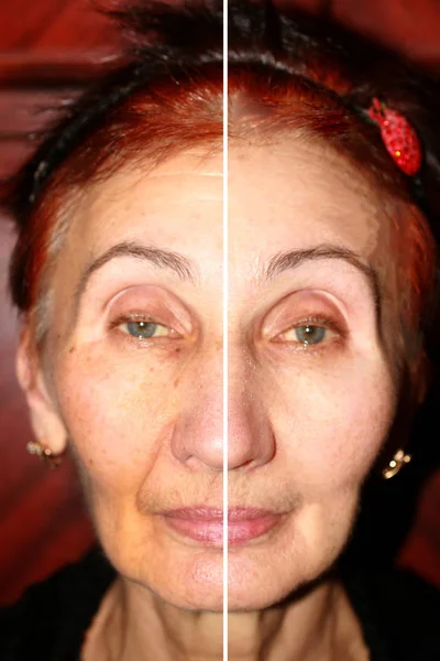 Pigmentasyon yüzünde. Kahverengi lekeler ve yüz cilt kırışıklıkları. Nazolabial kıvrım. Yarım yüz sağlıklıdır. Peeling, lazer, bothex. — Stok fotoğraf