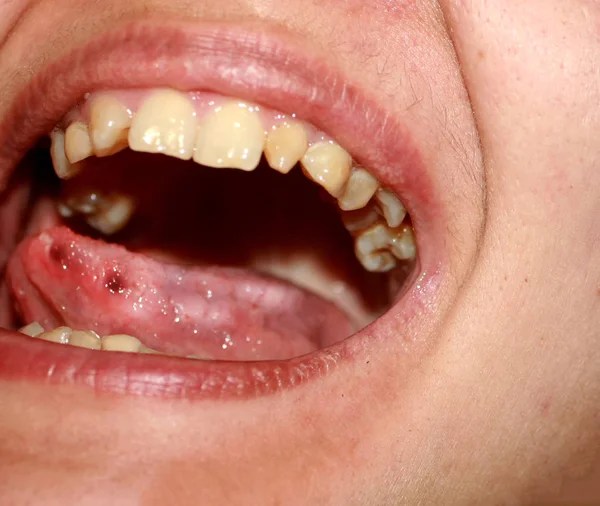 Estomatitis amfotoide. Candidiasis de la lengua. Úlcera en la lengua. Hongos Candida . — Foto de Stock