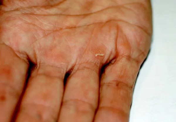 Schwielen Der Handfläche Und Den Fingern Der Hand Hühneraugen — Stockfoto