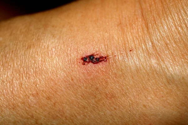 Scratch Abrasion Cut Skin Wound — Stock Photo, Image