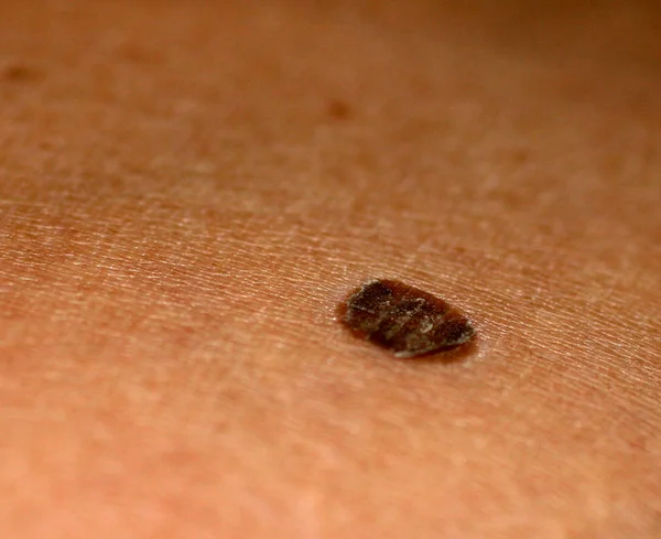褐色斑点 皮肤上鳞片斑斑的胎记 — 图库照片