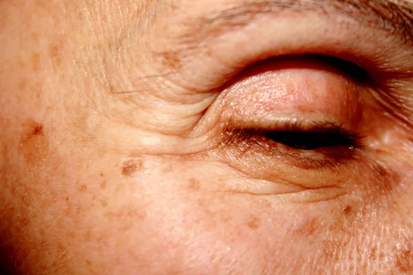 Wrinkles Eye Pigmentation Skin — Stock Photo, Image