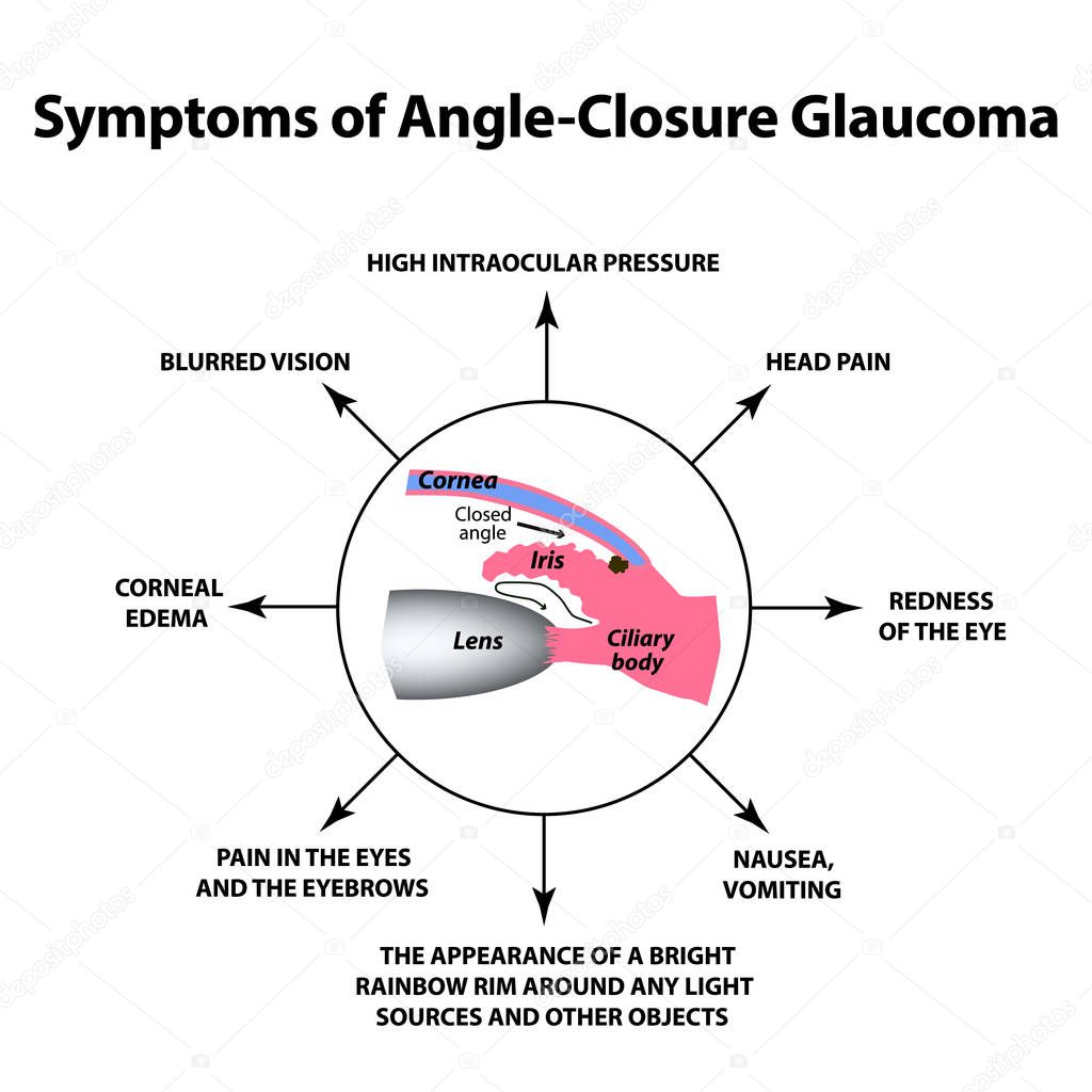 The symptoms of closed angle glaucoma. World glaucoma day. The anatomical structure of the eye. Infographics. Vector illustration on isolated background