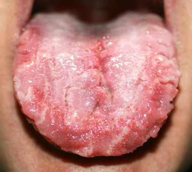 Geographic tongue, candidiasis, the language of the white coating candida clipart