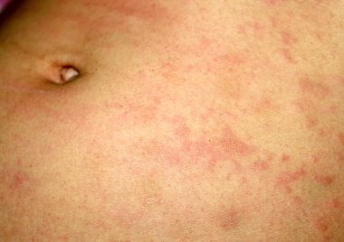 Pembe liken karın cilt üzerinde. Sedef hastalığı, dermatit, egzama, ürtiker, alerji.