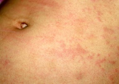 Pink lichen on the skin of the abdomen. Psoriasis, dermatitis, eczema, urticaria, allergies. clipart