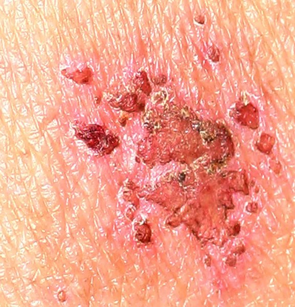 Wound on the skin. Psoriasis, dermatitis, eczema. — 图库照片