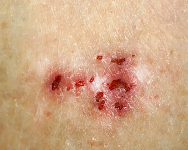 Blessure sur la peau. Psoriasis, dermatite, eczéma . — Photo