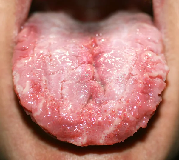 Geographic tongue, candidiasis, the language of the white coating candida — 图库照片