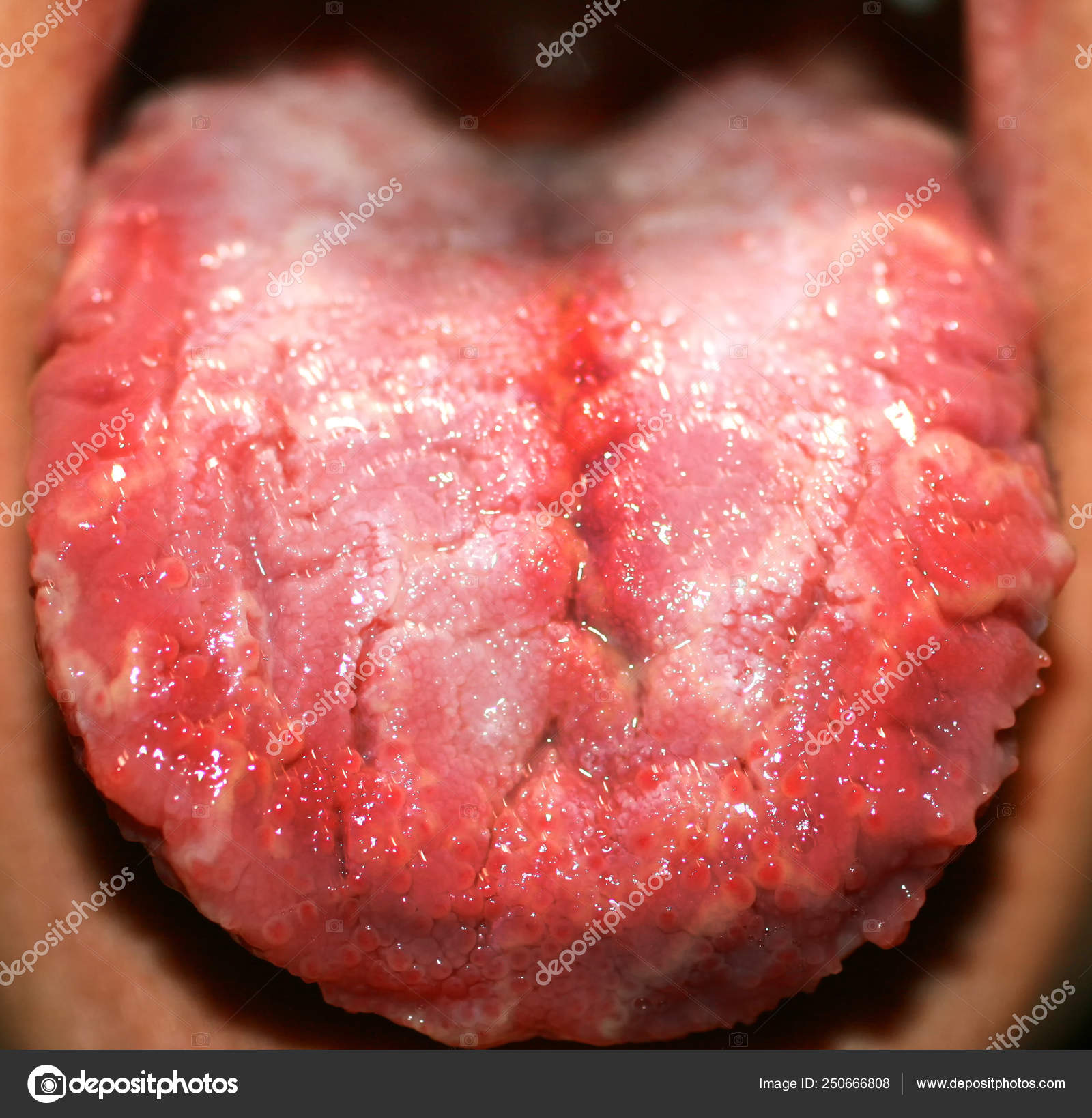 Albums 96+ Pictures Photos Of Thrush On Tongue Completed